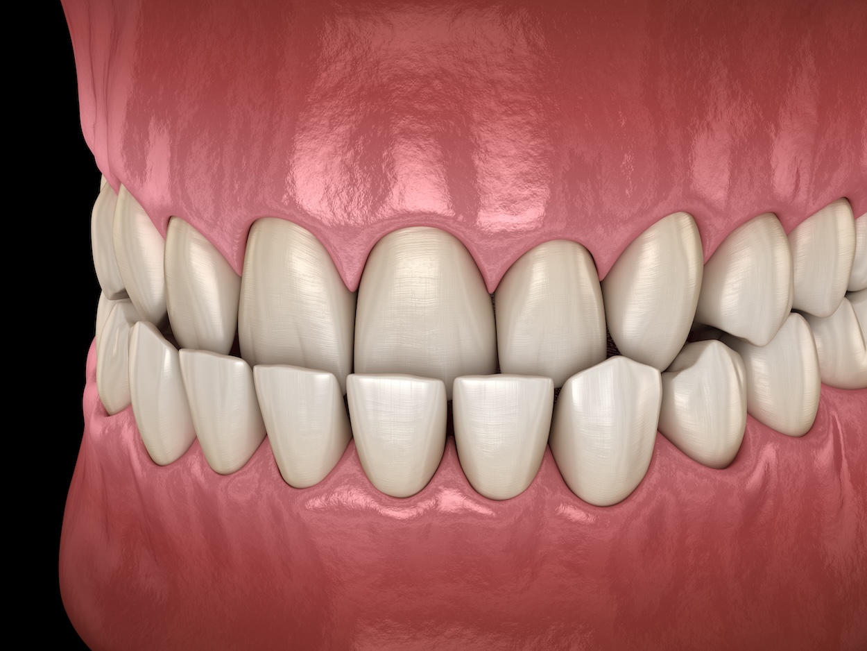 underbite treatment, orthodontic treatment, Hoover AL, Backus Orthodontics, braces, retainers, clear aligners, orthodontic appliances