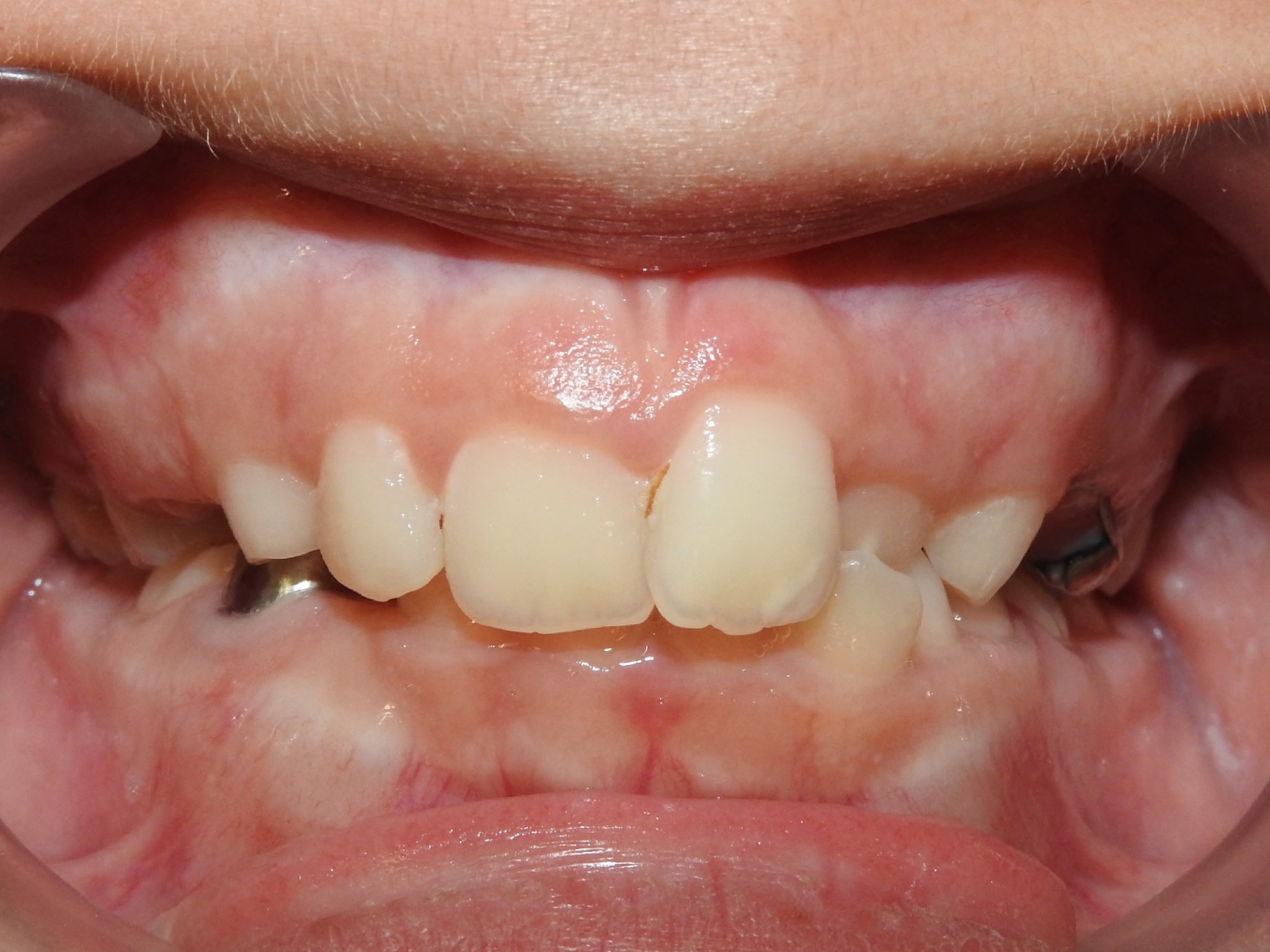 CAsey KNerr before IR Frontal Intraoral Photo