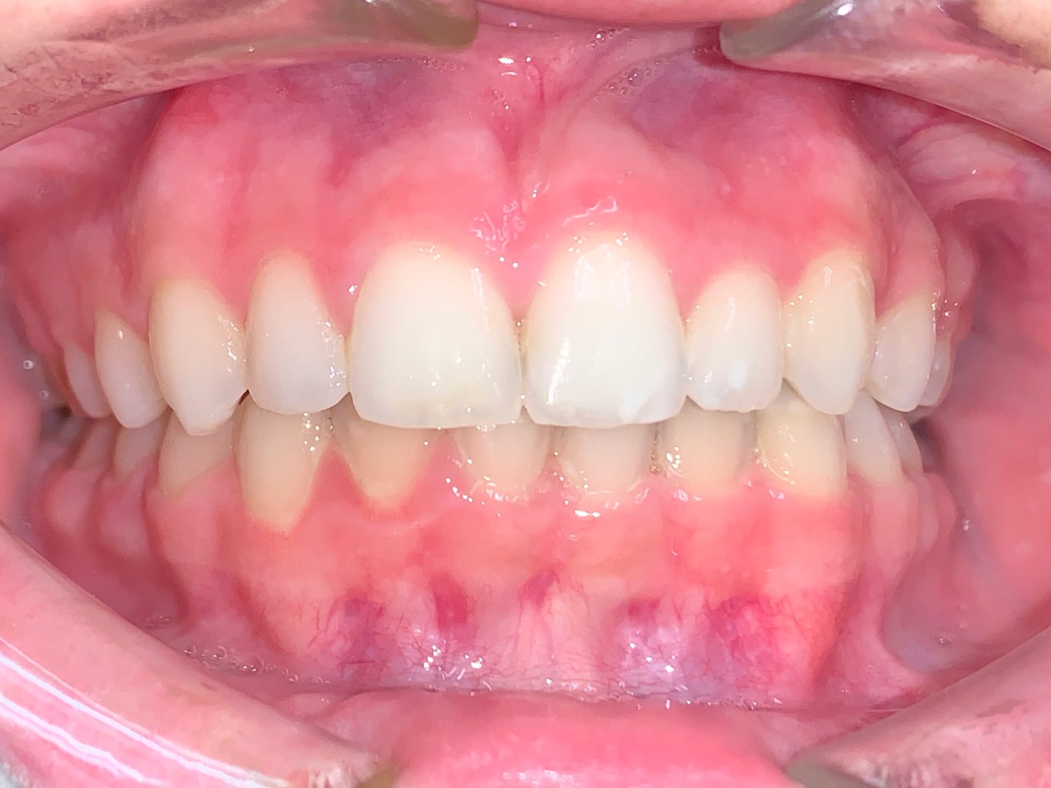 CAsey knerr Final Frontal Intraoral Photo