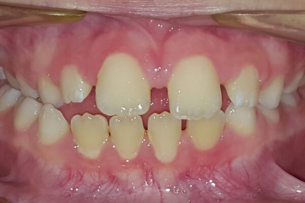 rouke beforeFrontal Intraoral Photo